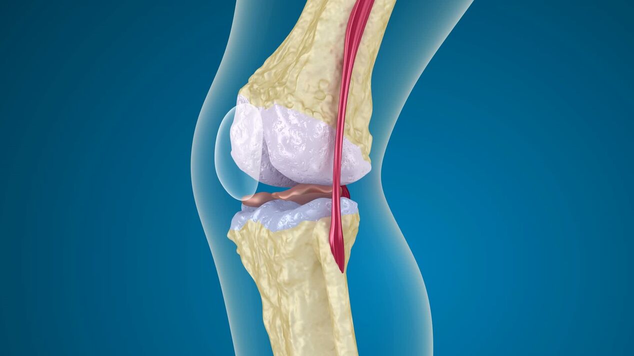 destruction de l'articulation du genou avec l'arthrose