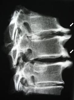 Les ostéophytes de la colonne cervicale provoquent des douleurs cervicales.