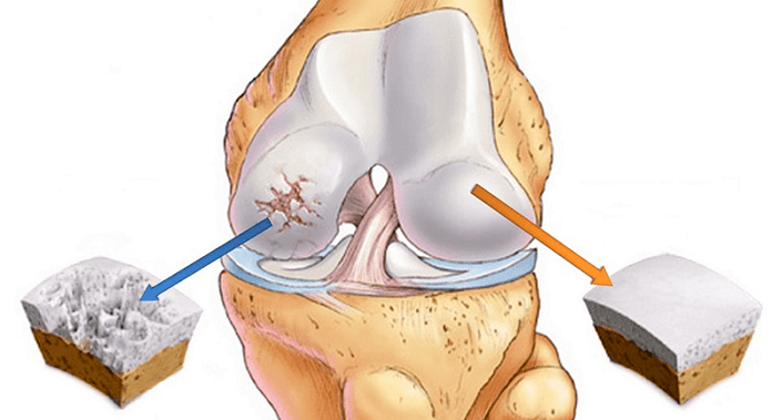 Cartilage sain et cartilage affecté par l'arthrose.